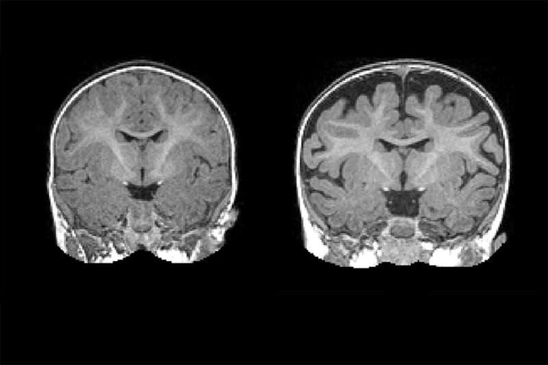 Infant MRIs show autism linked to increased cerebrospinal fluid