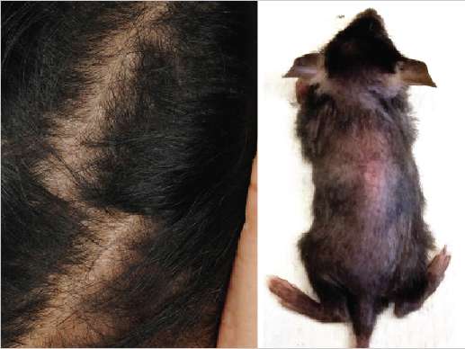 Inherited, rare skin disease informs treatment of common hair disorders, Penn study finds