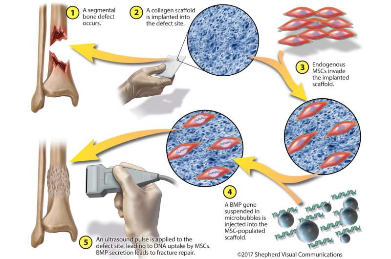 Injured bones reconstructed by gene and stem cell therapies