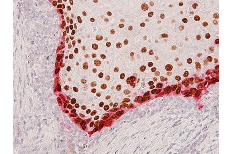 Invasive cells in head and neck tumors predict cancer spread
