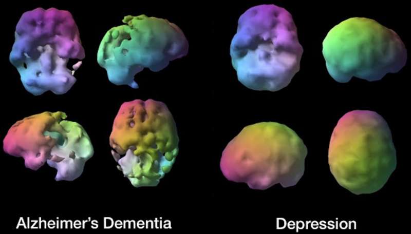 Is it depression or dementia? Brain SPECT imaging helps distinguish them