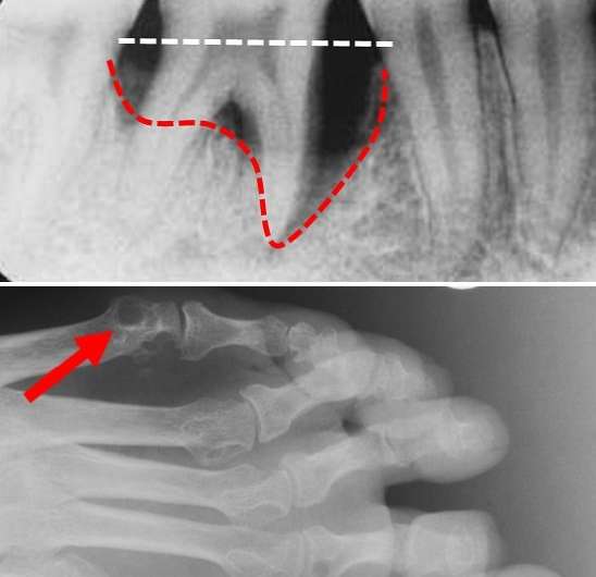 Jawbone loss predates rheumatoid arthritis
