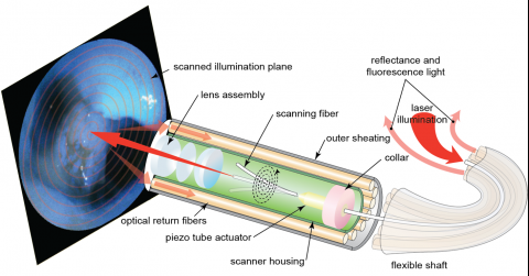 Laser-based camera improves view of the carotid artery