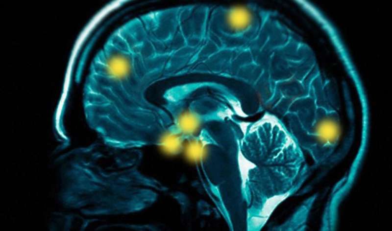 Longtime antidepressant could slow Parkinson's