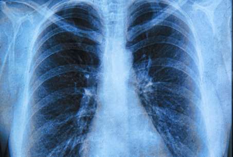 Lung cancer treatment could be having negative health effect on hearts