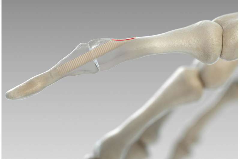 Making surgical screws from bones