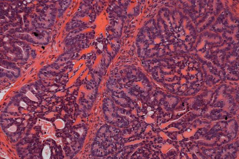 Mark of malignancy identified in prostate cancer