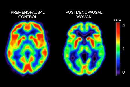 Menopause triggers metabolic changes in brain that may promote Alzheimer's