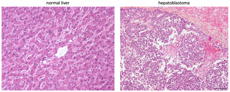 Metabolism can be used to subtype hepatoblastoma tumors
