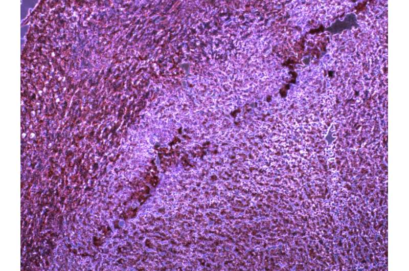 MicroRNA helps cancer evade immune system
