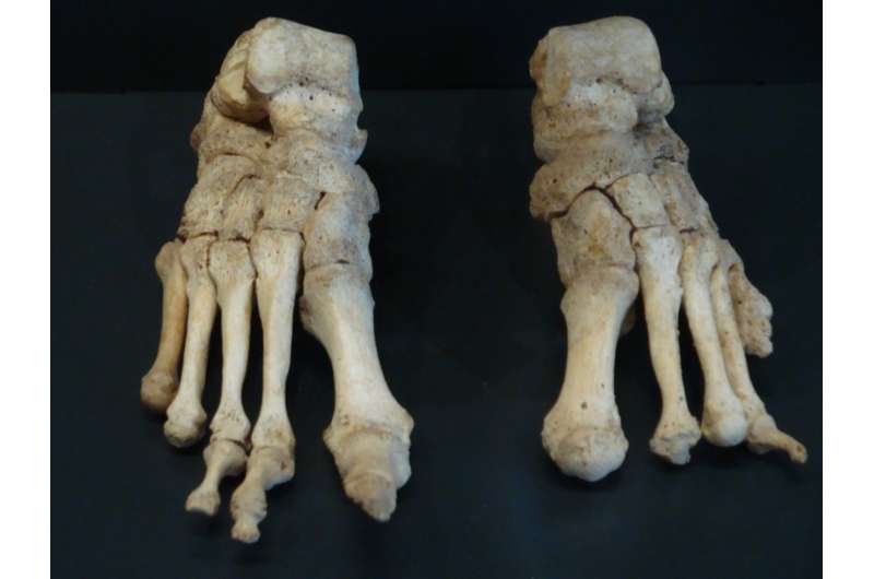 Morbidity and mortality of leprosy in the Middle Ages