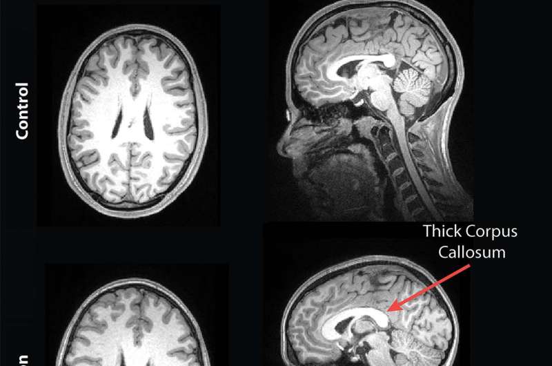 MRI reveals striking brain differences in people with genetic autism