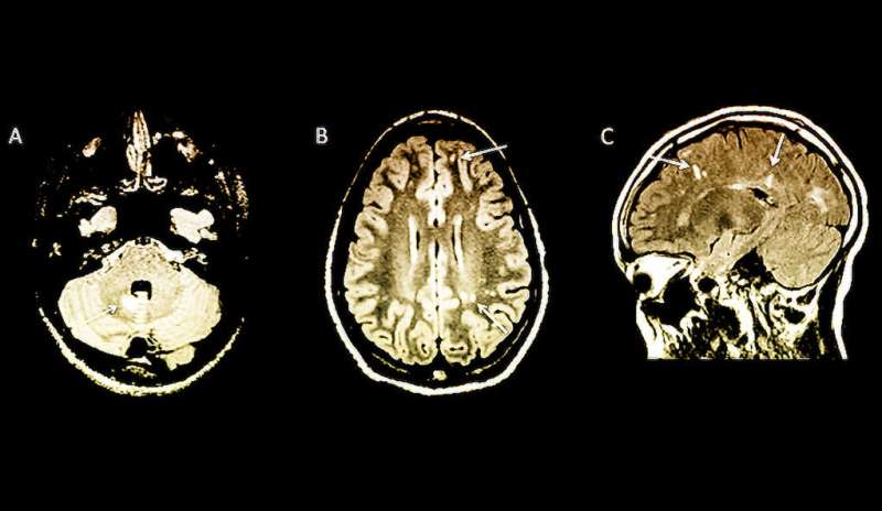 MS risk in children spotted with MRI brain scans