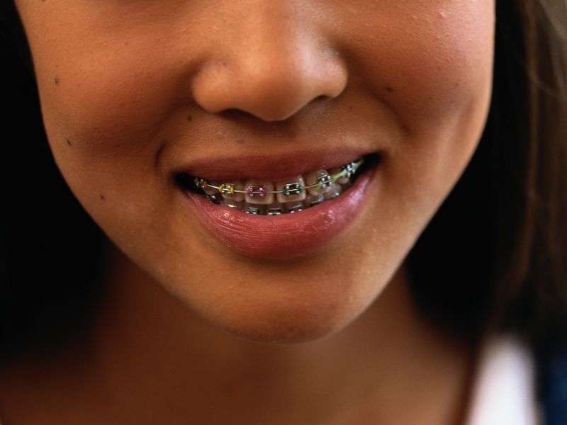 Need braces? say goodbye to 'Metal-mouth' taunts