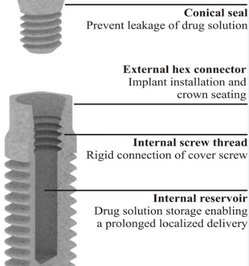New dental implant with built-in reservoir reduces risk of infections