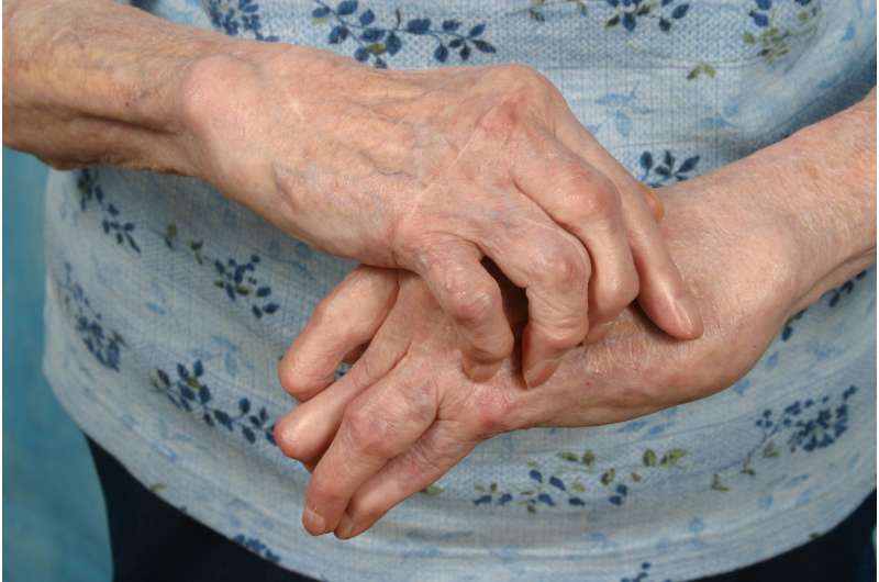 New hope for osteoarthritis patients suffering severe pain in hands