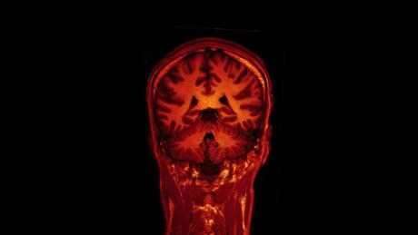 新方法识别最有可能导致癫痫发作的大脑区域