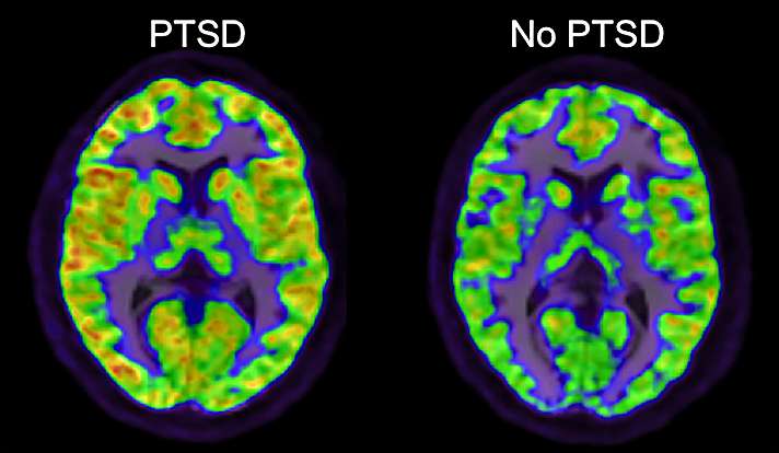 New PTSD study identifies potential path to treatment