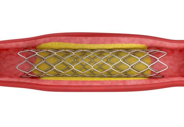 New stenting tool could make heart procedures cheaper and less painful