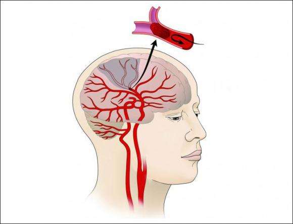 New stroke treatment proves effective, both medically and financially