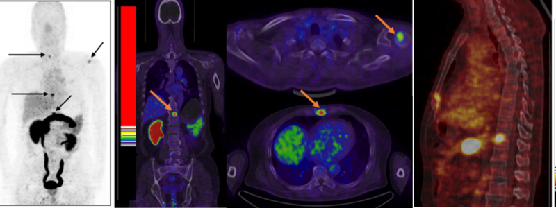 New type of PET imaging identifies primary and metastatic prostate cancer
