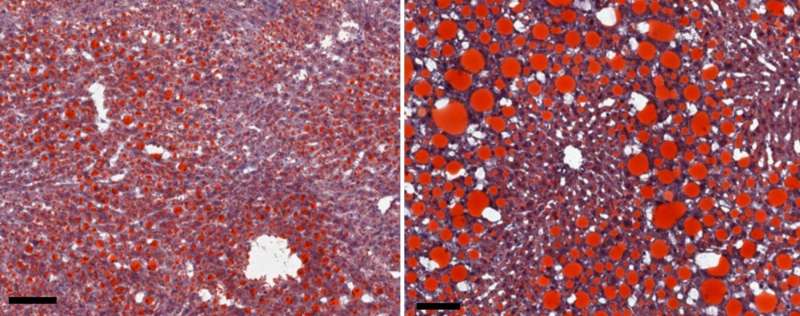 NIH study sheds light on immune responses driving obesity-induced liver disease