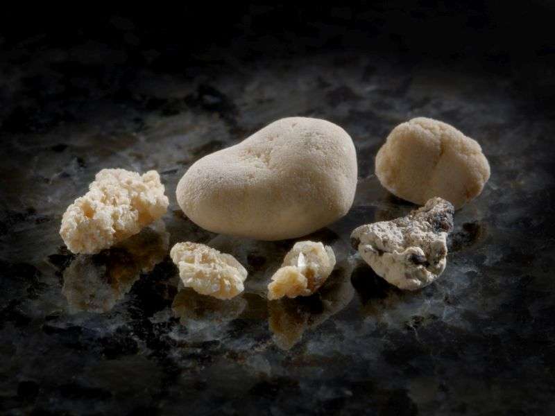 Normal vitamin D intake not linked to kidney stone risk