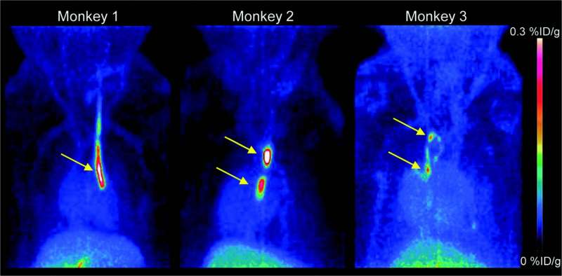 Novel PET tracer detects small blood clots