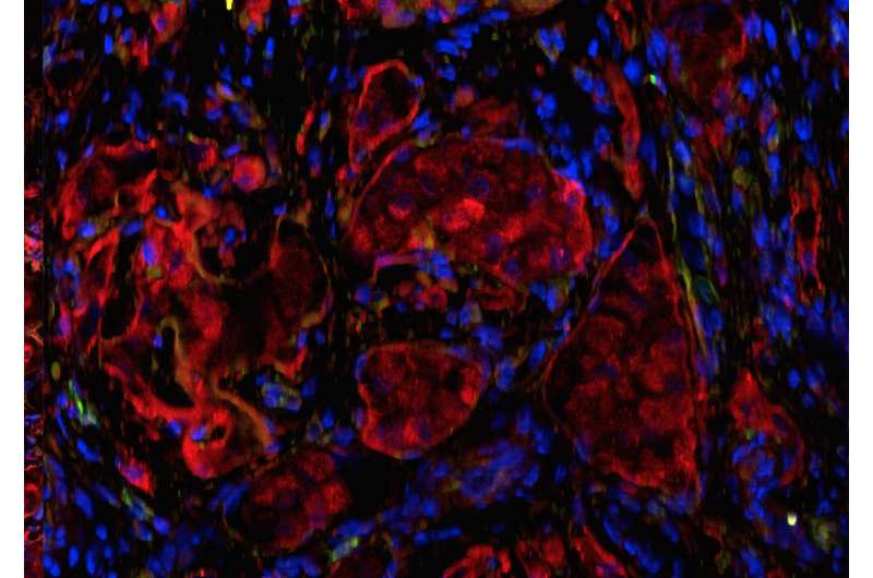 Novel tissue-engineered islet transplant achieves insulin independence in type 1 diabetes
