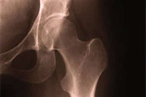 No 'weekend admission effect' for the elderly sustaining broken hips in the NHS