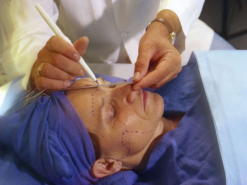 'Optimal' facelifts do make you look younger, study finds