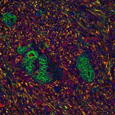 Pancreatic tumors rely on signals from surrounding cells