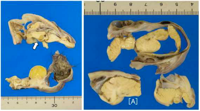 Partially developed brain found in young girl’s ovary