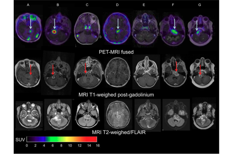 PET/CT有助于预测儿童脑肿瘤的治疗效果