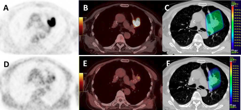 Phase II Ssudy: Radiotherapy dose increase to hypoxic NSCLC lesions