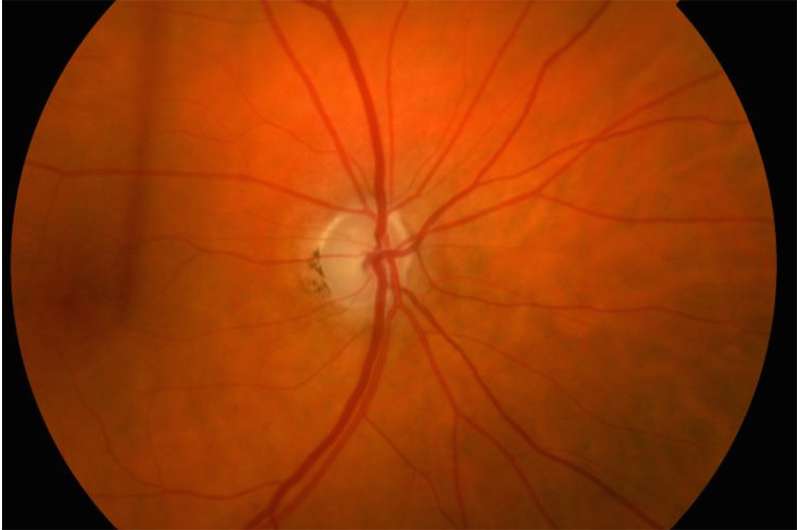 Potential predictor of glaucoma damage identified