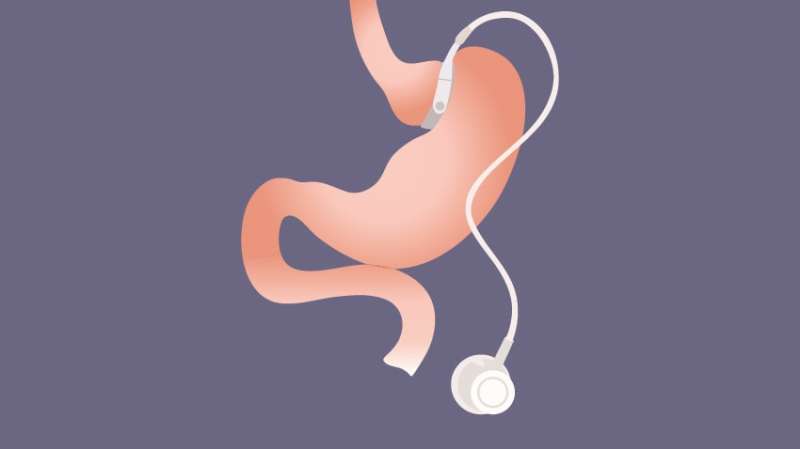 Probing problems with bariatric surgery: Reoperations, variation are common