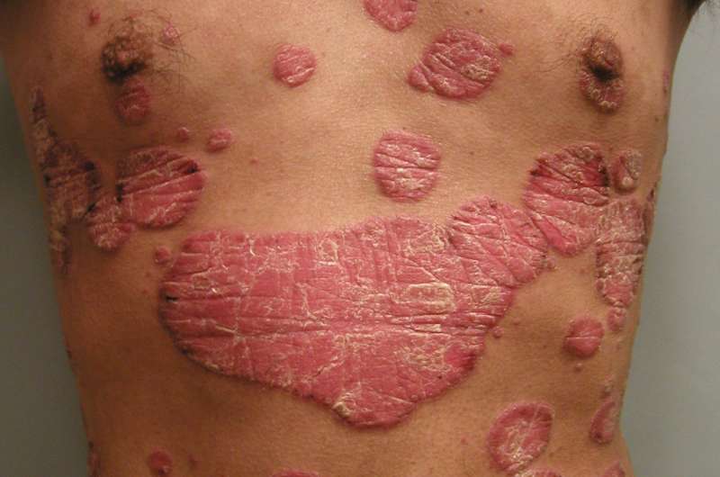 Psoriasis severity linked to increased risk of type 2 diabetes