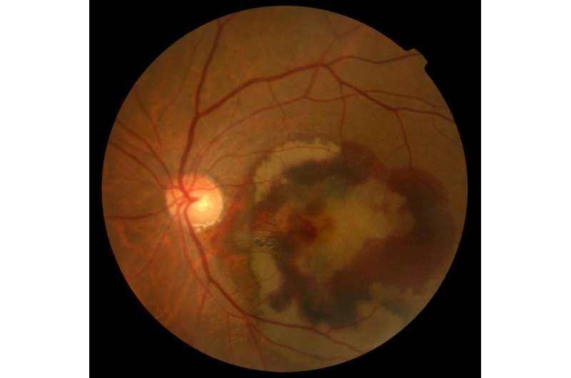 Reproducing a retinal disease on a chip