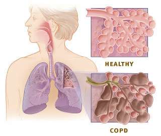 Repurposing heparin for inhalation may offer hope to millions with COPD