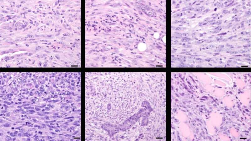 Researchers find key genetic driver for rare type of triple-negative breast cancer