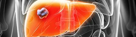 Risk of liver cancer low in patients with cirrhosis, study finds