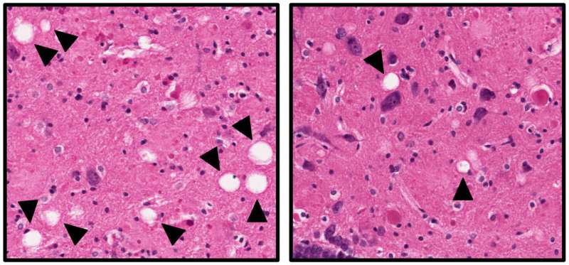 Saving neurons may offer new approach for treating Alzheimer's disease