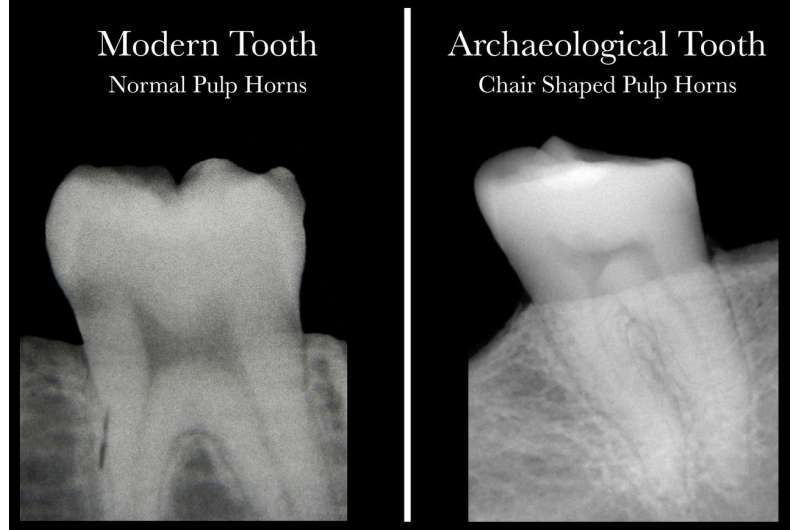 Science meets archaeology with discovery that dental X-rays reveal Vitamin D deficiency