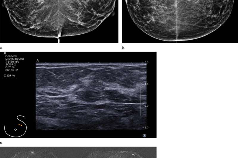 Screening MRI benefits women at average risk of breast cancer
