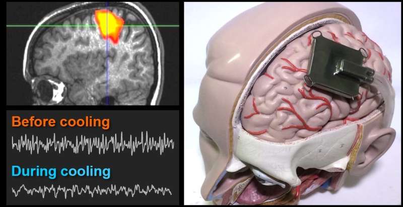 Simulating a brain-cooling treatment that could one day ease epilepsy
