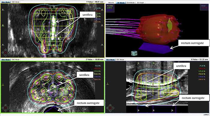 Single dose of brachytherapy may be an effective treatment for localized prostate cancer