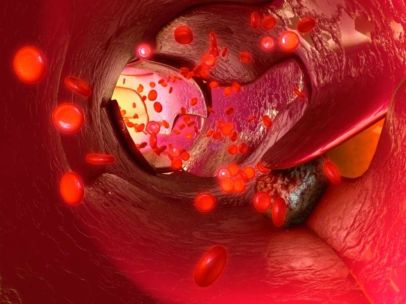 Spaser can detect, kill circulating tumor cells to prevent cancer metastases, study finds