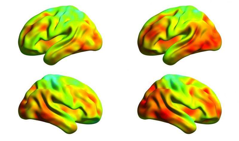 Spread of tau protein measured in the brains of Alzheimer’s patients