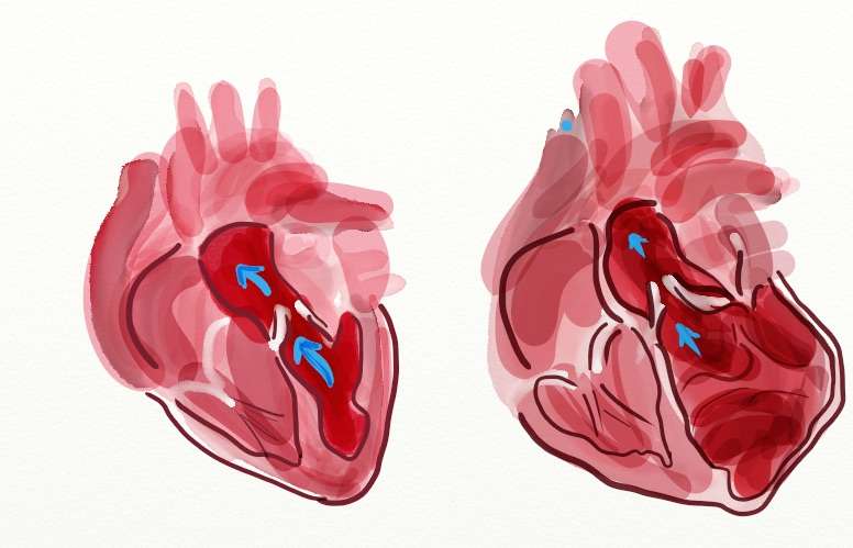 Study on transplanted hearts reveals risk genes for cardiovascular diseases